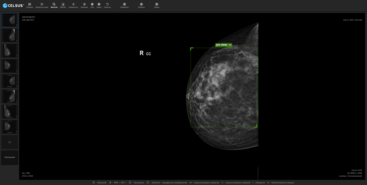 Can AI and radiologists work in harmony for double reading?